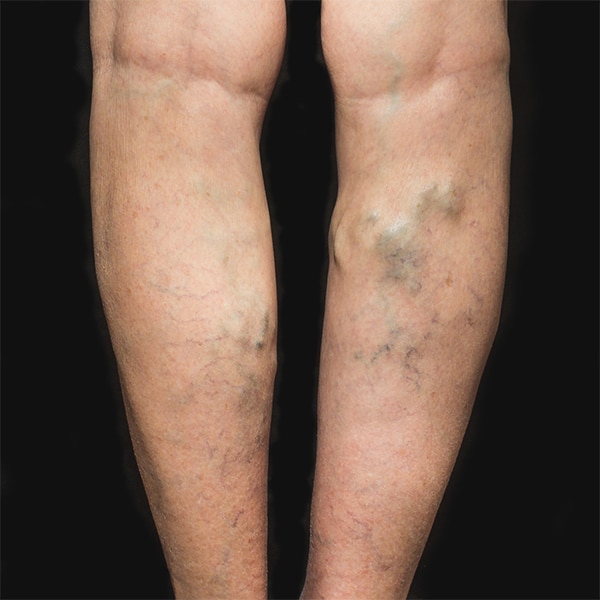 Legs with Varicose Veins in need of Varicose Vein Surgery. | BoxBar Vascular | Vein Clinic in Seattle