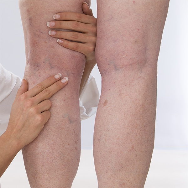 DVT Diagnosis of Woman with Leg Veins | BoxBar Vascular | Vascular Care in Seattle