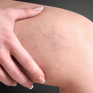 Spider Veins on a Woman's knee | Spider Vein and Vascular Treatment in Seattle at BoxBar Vascular.